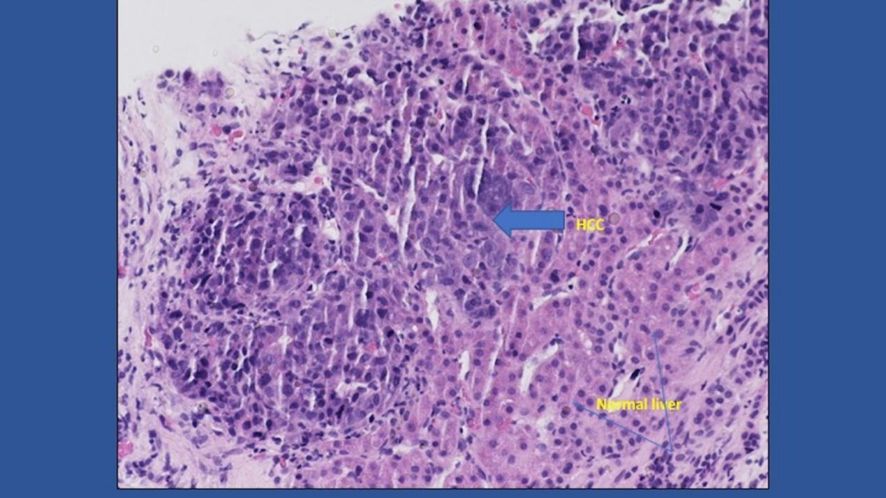 罕见!肝细胞癌侵犯胆囊