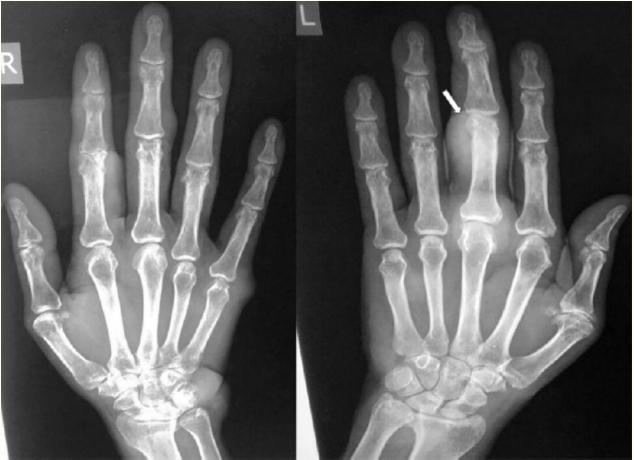 双手的x线片显示无骨受累.左手(图2),足部及左膝x线片显示皮下结