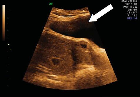 经腹超声提示:妊娠胚胎一个位于子宫内正常生长,另一个位于剖腹产疤痕