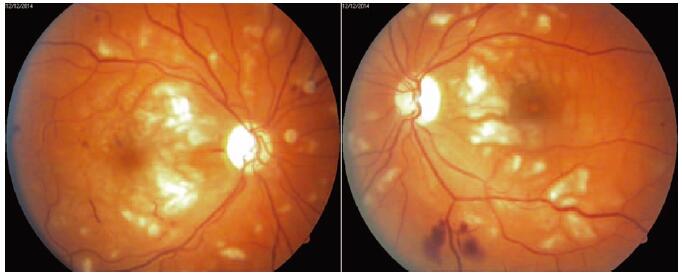 右眼(左側)缺血性黃斑病變,血管通透性增加;左眼(右圖)缺血性黃斑病變