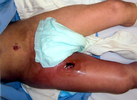 病案胰腺导管内乳头状粘液腺瘤破裂导致延伸至大腿的胰瘘