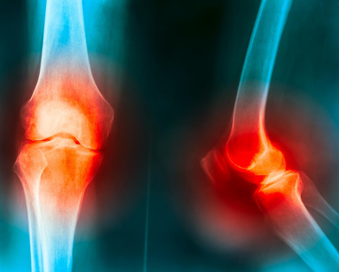 【news】骨关节炎:减轻体重可减慢膝关节退行性改变
