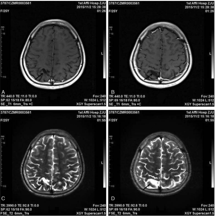 病案medicine脑顶叶软化所致精神分裂