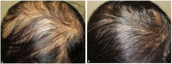 病案一例系统性红斑狼疮患者的银屑病性脱发