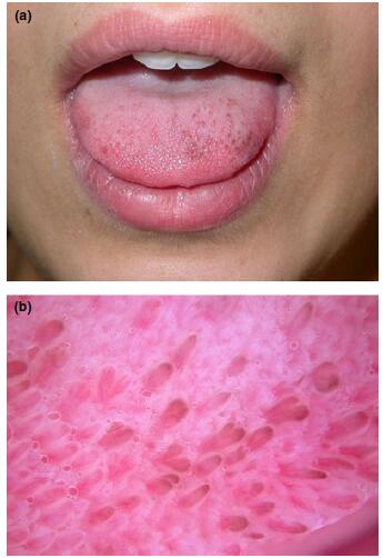 舌菌状乳头增生图片图片