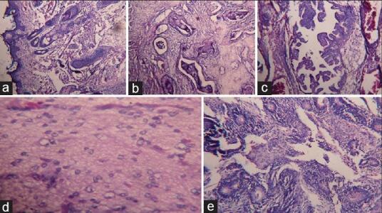 病案足以掩盖眼球的新生儿恶性眼眶畸胎瘤