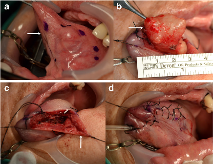 手术切除治疗,但术前未活检.术中黏膜下肿块完全切除(图4).