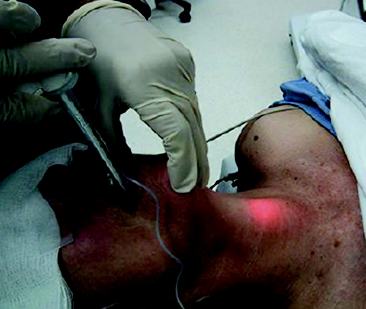 病案麻醉技术特殊方式气管插管光棒技术