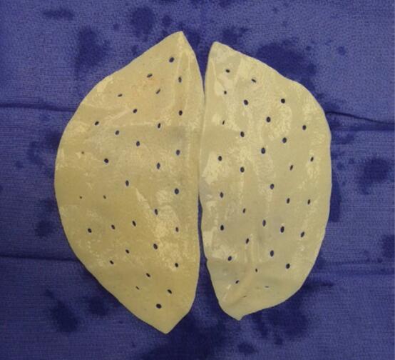 前沿前期乳房重建的发展趋势