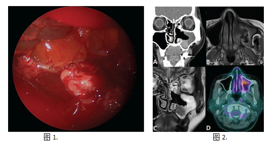 【病案】来源于内翻性乳头状瘤的鼻腔鼻窦未分化癌
