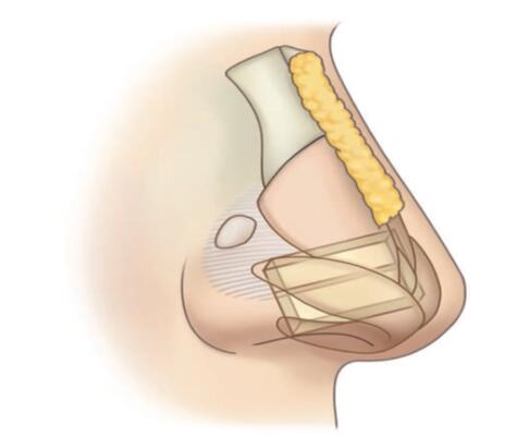 【前沿】鼻中隔型鼻尖成形术:间隔扩大移植与双层锥形软骨扩大移植的