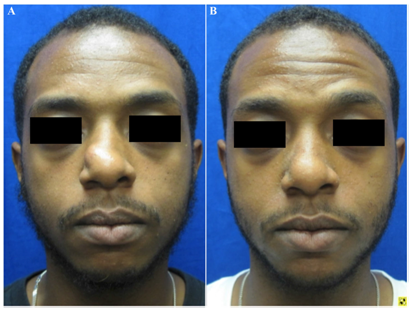 两周效果图图2 病例显示包裹中着肿瘤的梭形细胞和verocay小体术后1周