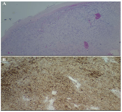 图2 病例显示包裹中着肿瘤的梭形细胞和verocay小体 术后1周,取出