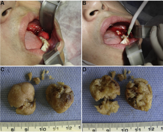 【病案】残留牙骨质母细胞瘤:牙源性肿瘤的罕见表现