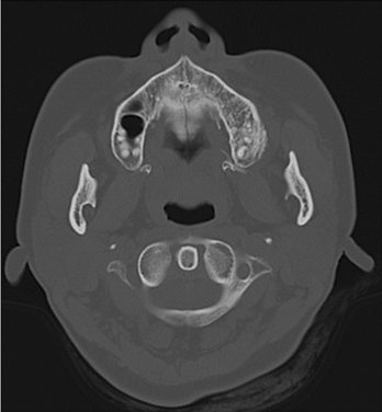 病案去分化的上颌骨骨旁骨肉瘤
