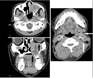 斷層掃描(ct)與和磁共振成像(mri)顯示38×48×50mm腫瘤位於左上頜竇