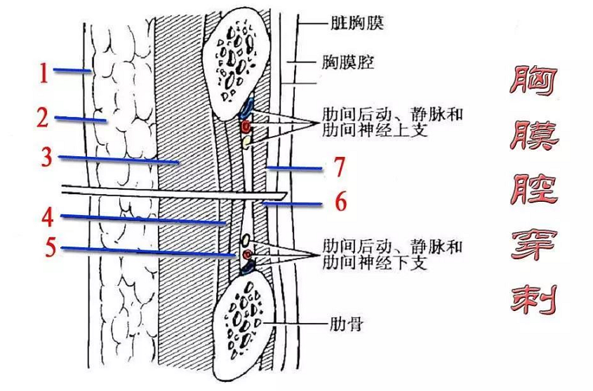 骨髓穿刺点体表定位图图片