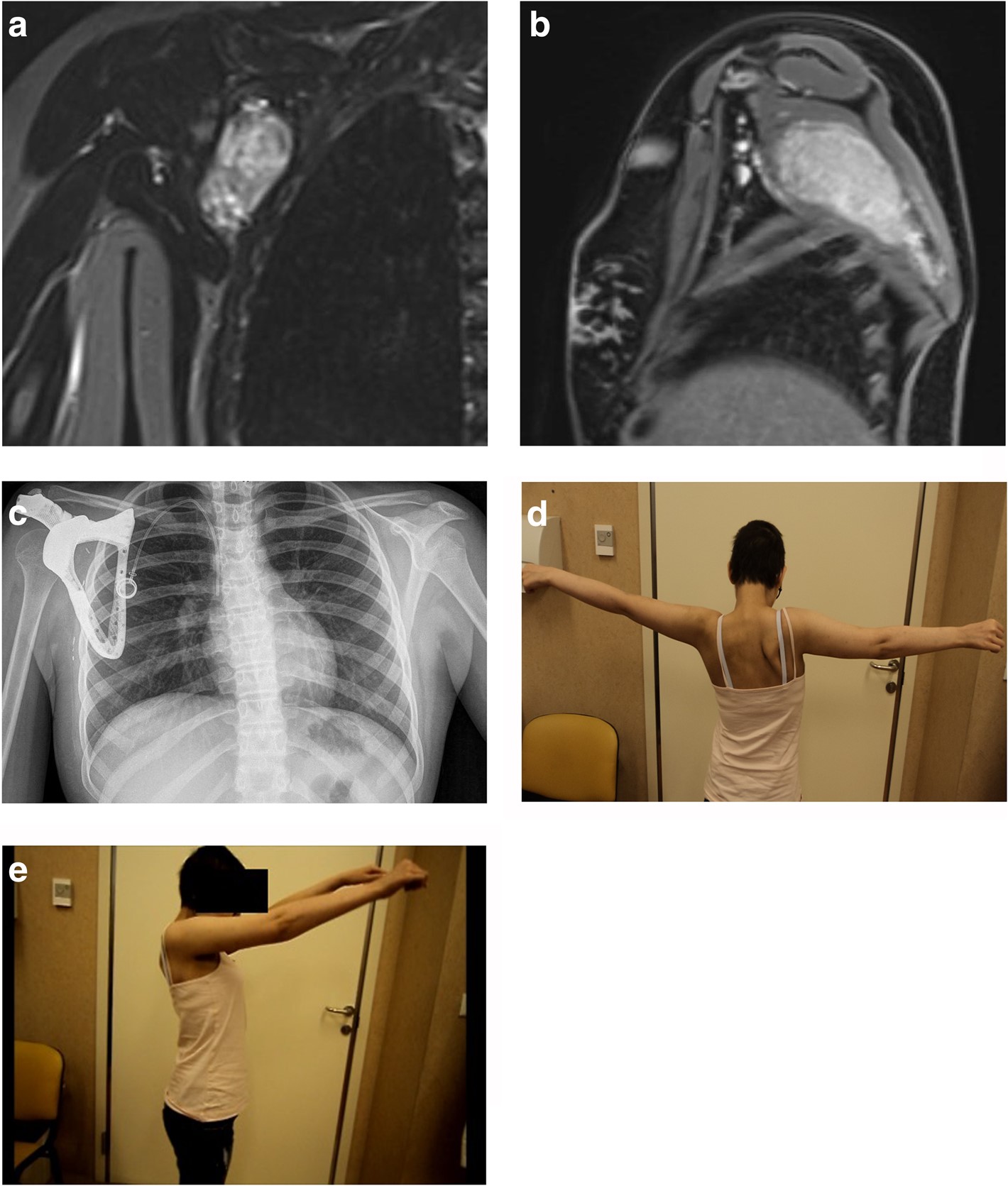 肩胛骨肿瘤早期症状图片