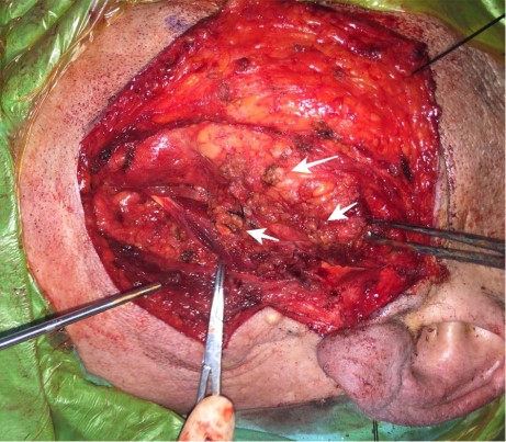 双侧腮腺多灶性结节状癌细胞增生