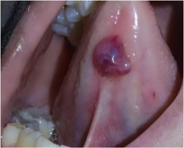 口腔血管瘤图片初期图片
