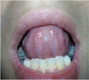 舌头上面有血管瘤图片图片