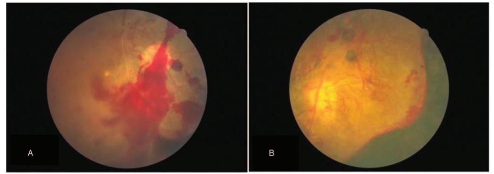 兩眼均有新生血管形成和視網膜及玻璃體出血.
