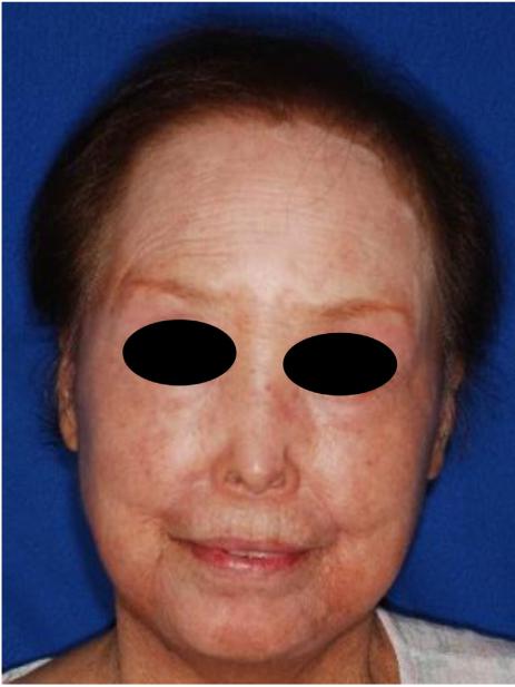 体格检查:身高142cm,体重36kg,脸部硬皮病样皮肤变化(图1).