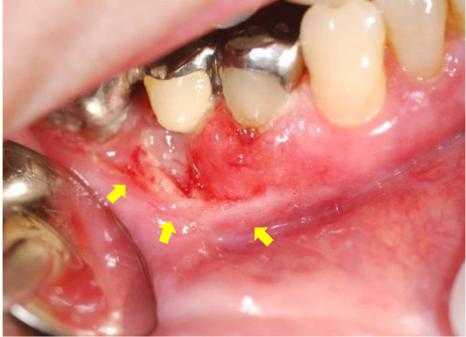 图2 下牙槽和牙龈癌:在右下颌第二前磨牙对应的颊侧牙龈上观察到溃疡