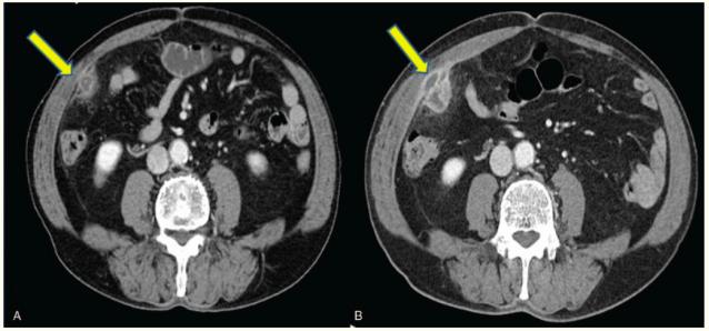 吞食牙签引起肠穿孔致腹腔脓肿