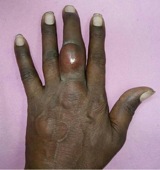 既往有糖尿病和高血压病史,因双手和右膝关节多发无痛性结节就诊.