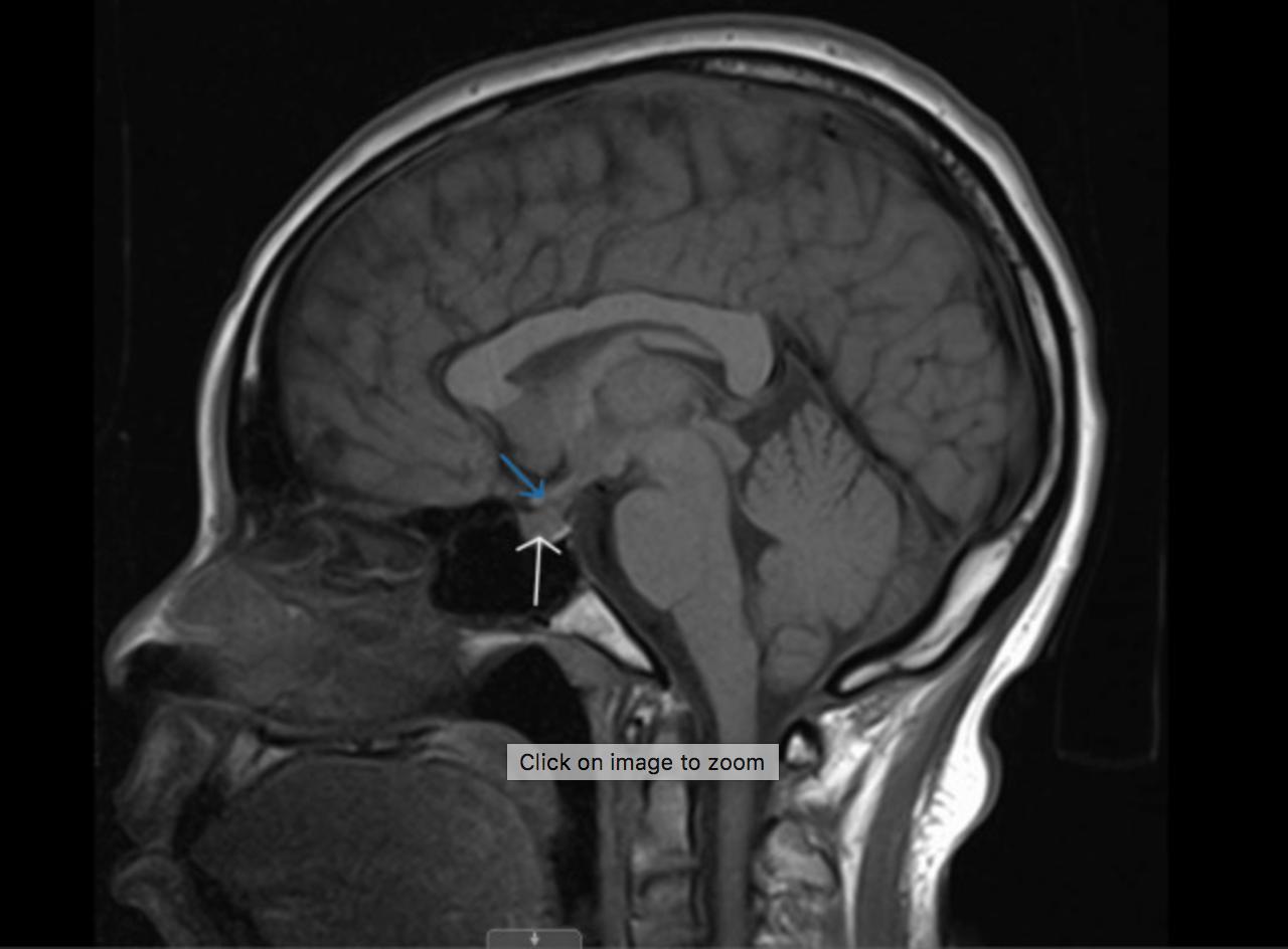 图1 脑mri,矢状切面.白色箭头:垂体;蓝色箭头:垂体柄